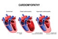 Hypertrophic cardiomyopathy, dilated cardiomyopathy and healthy Royalty Free Stock Photo
