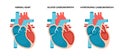 Types of heart diseases - normal, hypertrophic and dilated cardiomyopathy. Human heart muscle diseases cross-section. Royalty Free Stock Photo