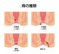 Types of Hemorrhoid flat vector illustration Japanese