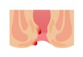 Types of Hemorrhoid flat vector illustration no text