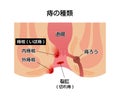 Types of Hemorrhoid flat vector illustration Japanese