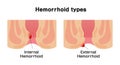 Types of Hemorrhoid vector illustration
