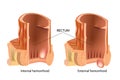 Types of Hemorrhoids. Hemorrhoids, also called piles