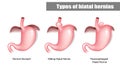 Types of hiatal hernias sliding and paraesophageal.