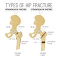 Types of hip fracture Royalty Free Stock Photo