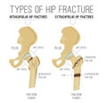 Types of hip fracture