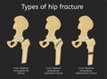 Types of hip fracture