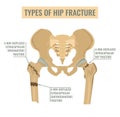 Types of hip fracture