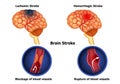 Types of human brain stroke