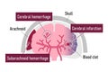 Types of human brain stroke vector illustration