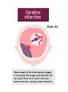 Types of human brain stroke vector illustration | Cerebral infarction