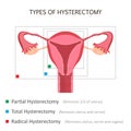 Types of Hysterectomy Royalty Free Stock Photo