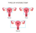 Types of Hysterectomy Royalty Free Stock Photo