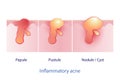 Types of inflammatory acne, papule, pustule, nodule and cyst vector on white background.