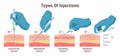 Types of injections. Guide to injecting medication into skin. Doctor holding