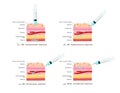 Types of injections set isometric vector illustration. Syringe angle vaccine injecting scheme