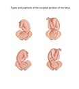 types of insertion of the fetal head in obstetrics Royalty Free Stock Photo