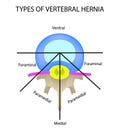 Types of location of the intervertebral hernia. Vector illustration on isolated background. Royalty Free Stock Photo