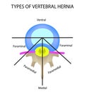 Types of location of the intervertebral hernia. Vector illustration on isolated background.