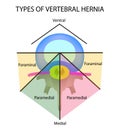 Types of location of the intervertebral hernia. Vector illustration on isolated background.