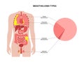 Mesothelioma tumor types