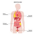 Mesothelioma tumor types Royalty Free Stock Photo