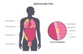 Mesothelioma tumor types