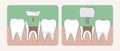 Types of Microprosthesis and Tooth Implantation, Flat Vector Stock Illustration or Collage with Ceramic Crown or Inlay