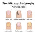 Types of nail psoriasis