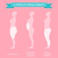 3 types of obesity. Figures of women in profile.