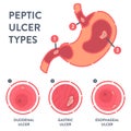 Types of peptic ulcer stomach disease infographics Royalty Free Stock Photo