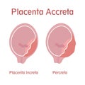 Types of placenta accreta: Placenta Increta and Percreta