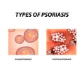 Types of psoriasis. Not pustular and pustular psoriasis. Eczema, skin disease dermatitis. Infographics. Vector