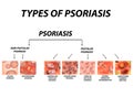 Types of psoriasis. Pustular and not pustular. Vulgar, erythroderma, erythrodermic psoriasis, persistent acrodermatitis Royalty Free Stock Photo