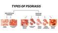 Types of psoriasis. Pustular and not pustular. Vulgar, erythroderma, erythrodermic psoriasis, persistent acrodermatitis Royalty Free Stock Photo