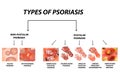 Types of psoriasis. Pustular and not pustular. Vulgar, erythroderma, erythrodermic psoriasis, persistent acrodermatitis Royalty Free Stock Photo