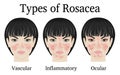 Types of Rosacea