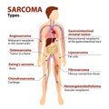 Types sarcoma Royalty Free Stock Photo