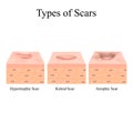 Types of scars. Acne scars. Keloid, hypertrophic, atrophic, normotrophic. The anatomical structure of the skin with acne Royalty Free Stock Photo