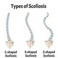 Types of Scoliosis. C, S, Z shaped scoliosis. Dextroscoliosis. Levoscoliosis. Spinal curvature, kyphosis, lordosis