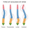 Types of scoliosis of spine.