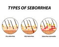 Types of seborrhea. Seborrhea skin and hair. Dandruff, seborrheic dermatitis. Baldness, hair growth, baldness