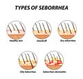 Types of seborrhea. Seborrhea skin and hair. Dandruff, seborrheic dermatitis. Baldness, hair growth, baldness