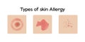 Types of skin allergy vector illustration design