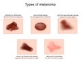 Types of melanoma