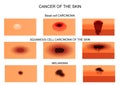 Types of skin cancer.