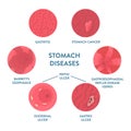 Stomach diseases detected by endoscopy medical procedure Royalty Free Stock Photo