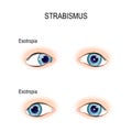 Strabismus. crossed eyes