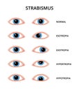Types of strabismus Royalty Free Stock Photo