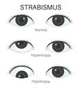 Types of strabismus-1